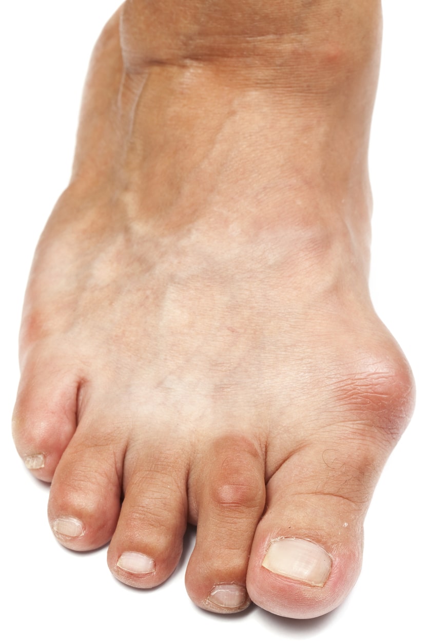 foot with large bunion sticking out of right side