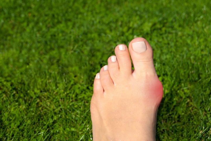 foot on grass with large red bunion sticking out